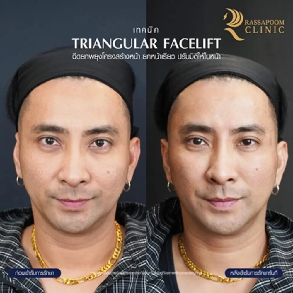 ผลลัพธ์หลังทำ โปรแกรม Triangular facelift