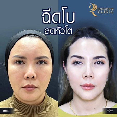 Botox injection for a large head and reducing the size of the nostrils