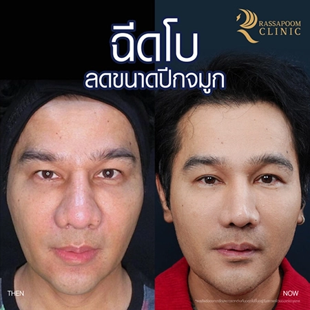 Botox injection for a large head and reducing the size of the nostrils