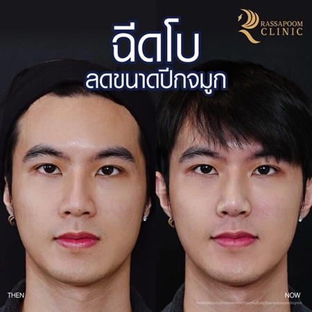 Botox injection for a large head and reducing the size of the nostrils