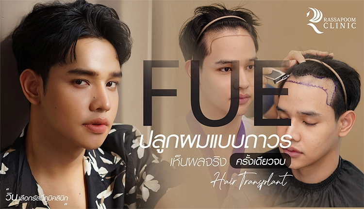 ผมบางหัวล้านหัวเถิก ปลูกผมด้วยเทคนิค FUE (คุณวิน)