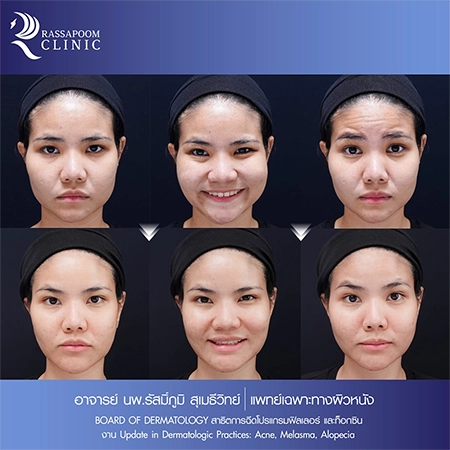Dr. Rasmipoom Sumethiwit demonstrates the injection of fillers and facial contouring agents.