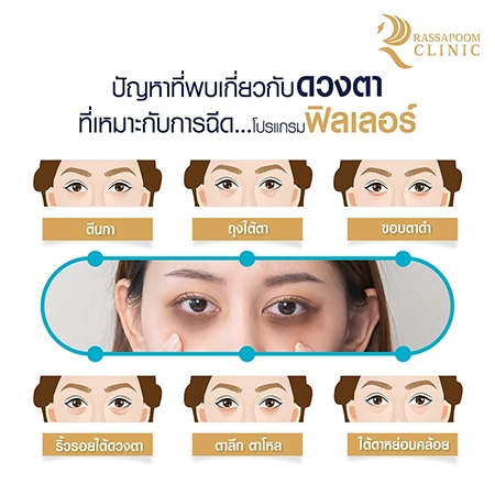 Under eye filler injections