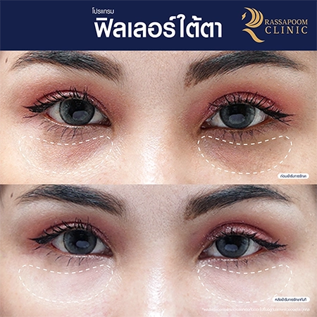 Under eye filler injections