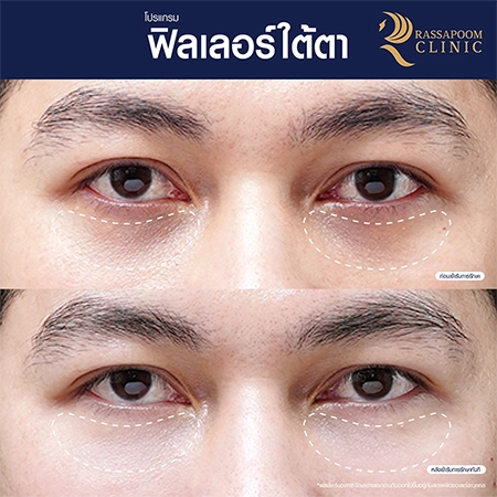 Under eye filler injections