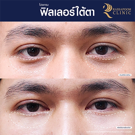 Under eye filler injections