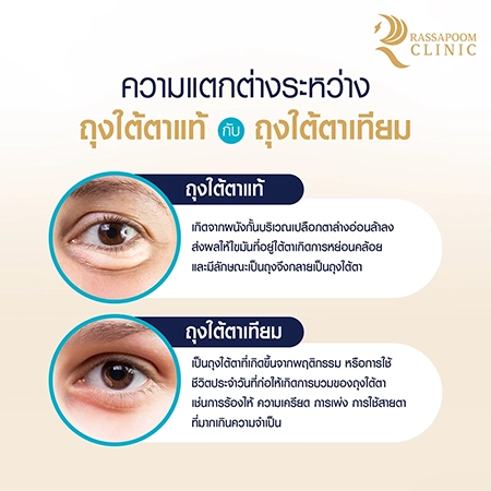 Under eye filler injections