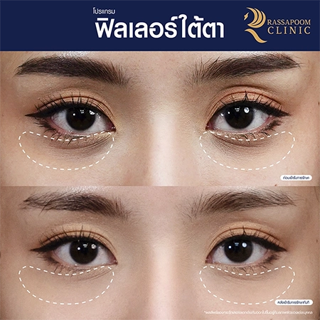 Under eye filler injections