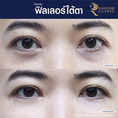 Under eye filler injections