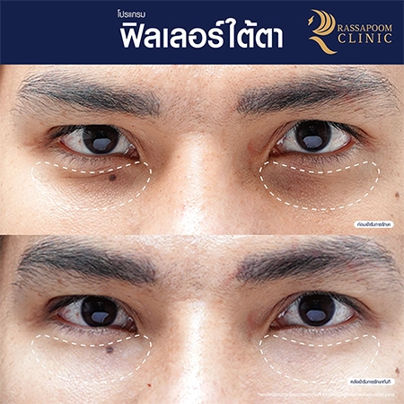 Under eye filler injections