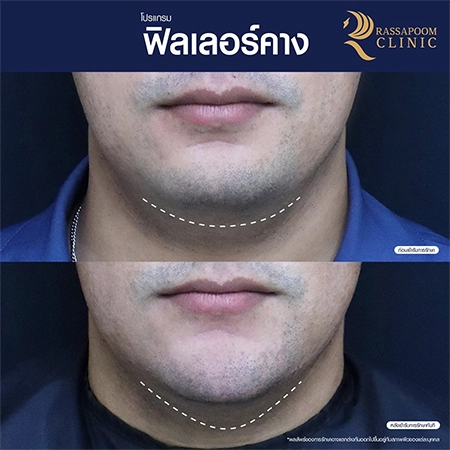 Chin filler