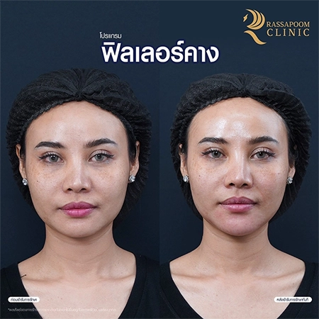 Chin filler