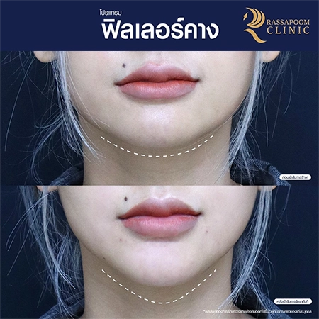 Chin filler