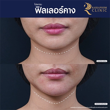 Chin filler