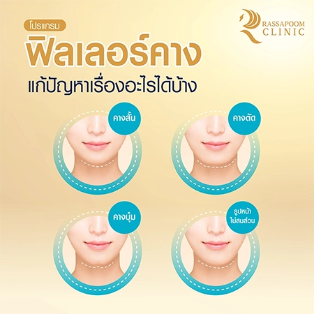 Chin filler