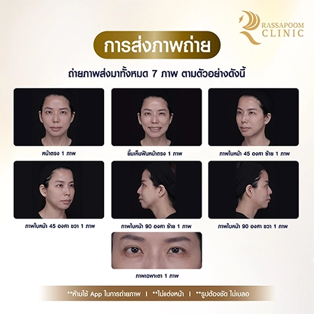 Free activity: 14 cc filler injection program (under eye filler)