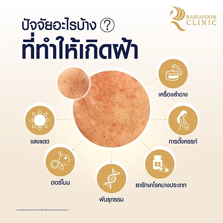Melasma
