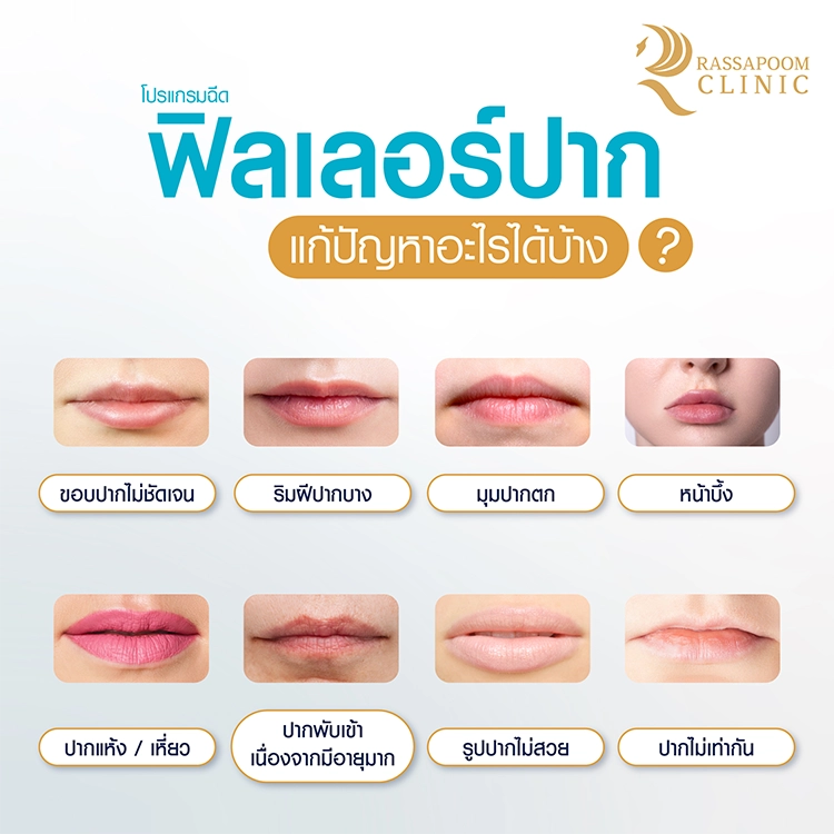 Lip filler injection