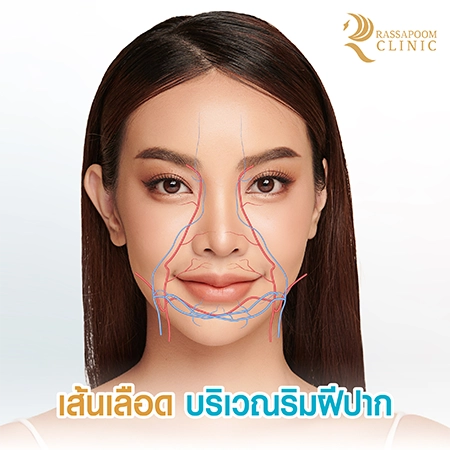 Lip filler injection