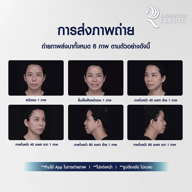 Free activity: 14 cc filler injection program (MID FACE)
