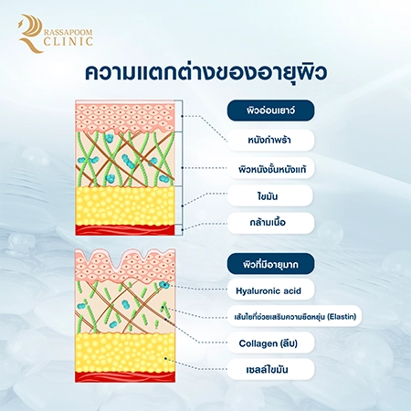 ความแตกต่างของอายุผิว Radiesse Tri-Lift