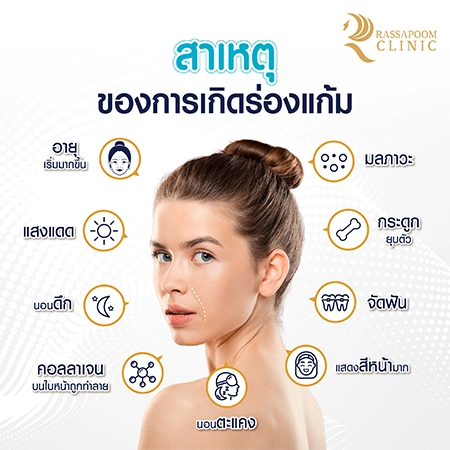 Cheek filler injections