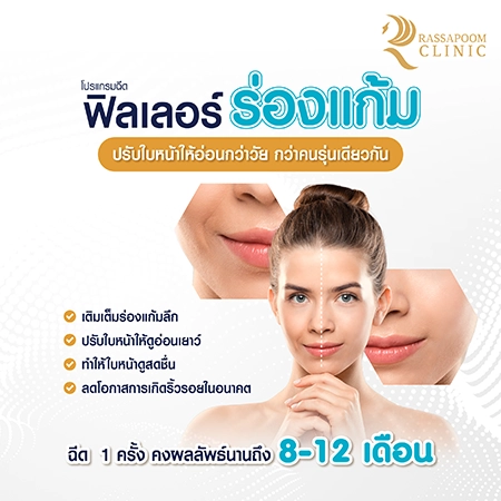 Cheek filler injections