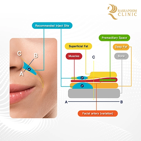 Cheek filler injections