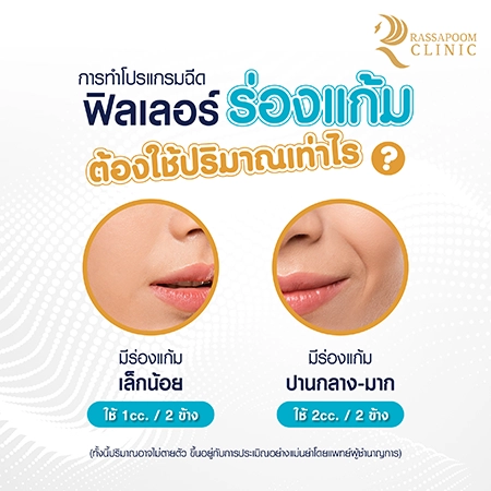 Cheek filler injections