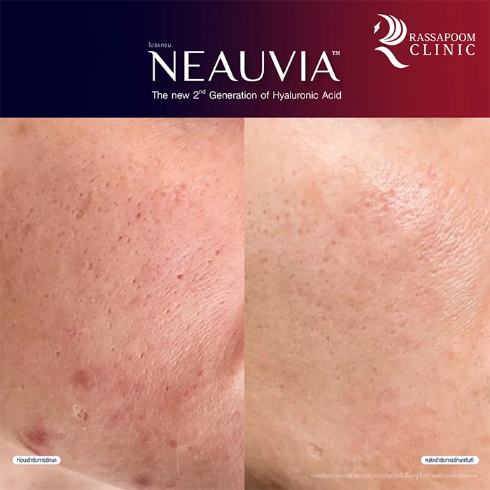 Neauvia filler