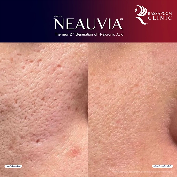 Neauvia filler