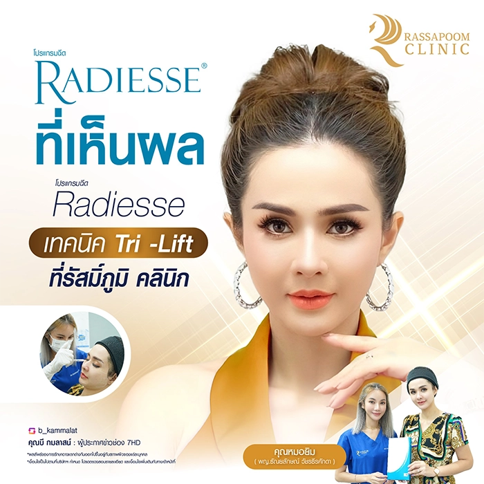 โปรแกรมฉีด Radiesse Filler ด้วยเทคนิค Tri-Lift (คุณบี กมลาสน์ เอียดศรีชาย)