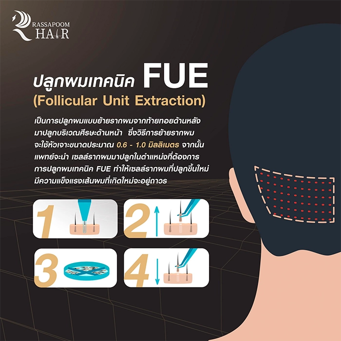 Hair transplant FUE FUE DHI