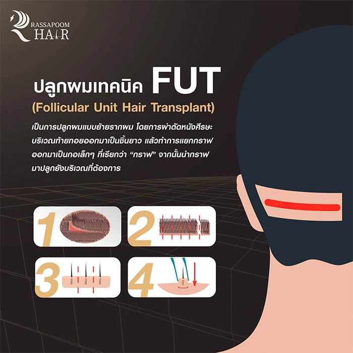Hair transplant FUE FUE DHI