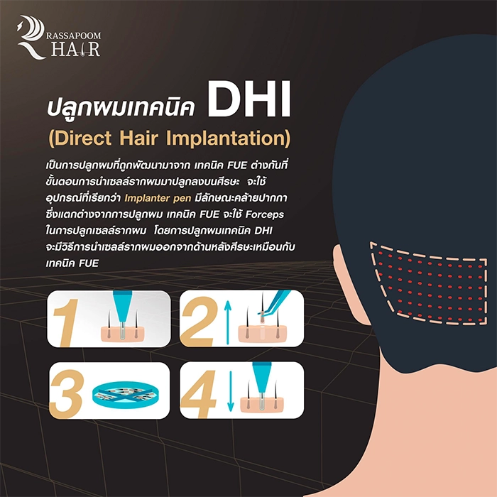 Hair transplant FUE FUE DHI