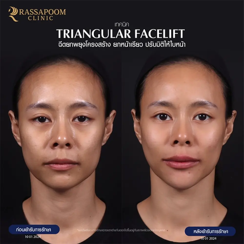 ผลลัพธ์หลังทำ โปรแกรม Triangular facelift