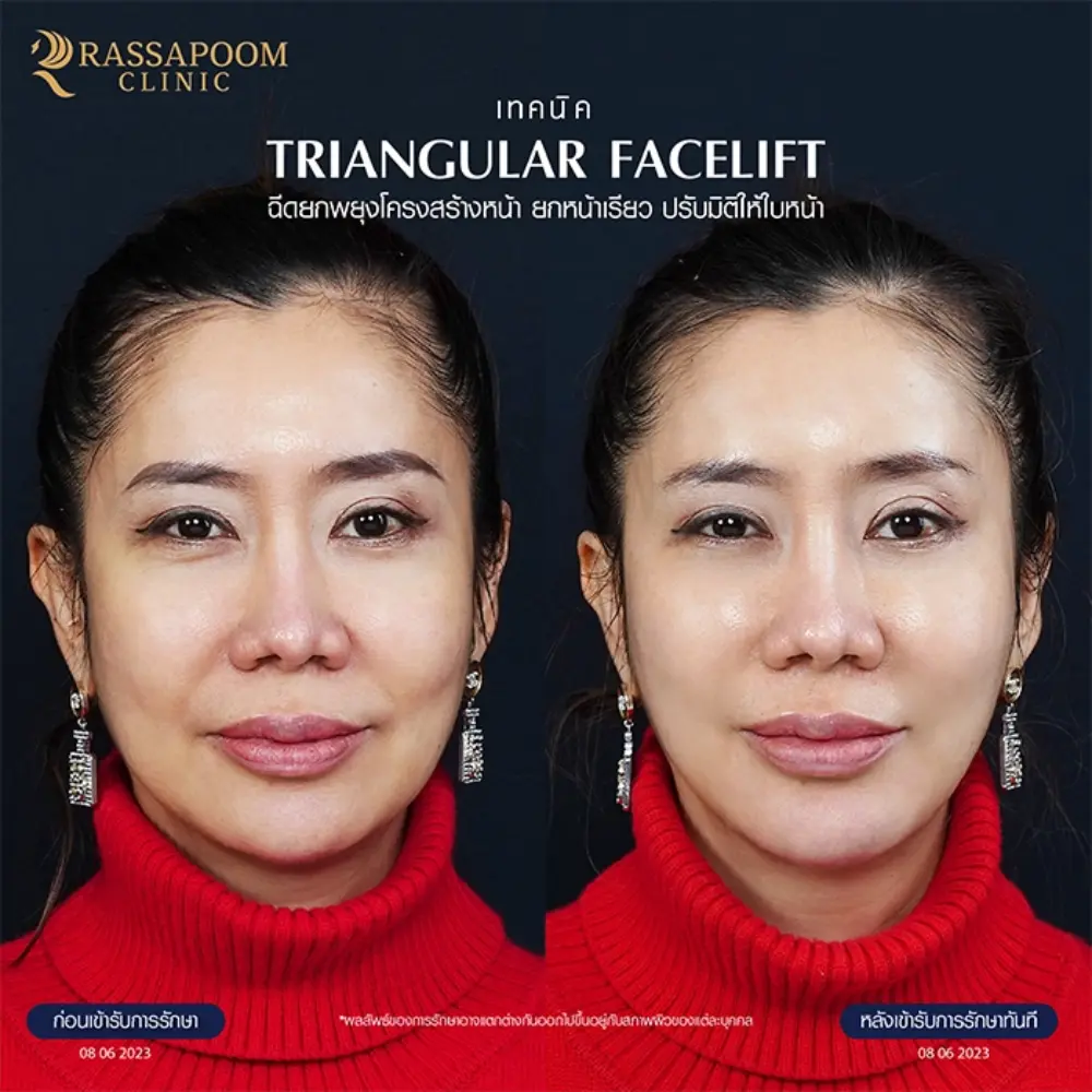 ผลลัพธ์หลังทำ โปรแกรม Triangular facelift