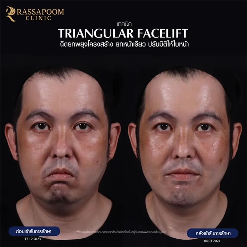 ผลลัพธ์หลังทำ โปรแกรม Triangular facelift