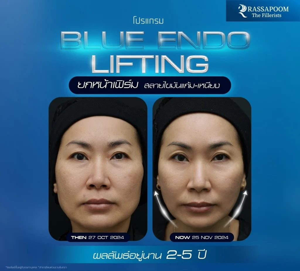 ผลลัพธ์หลังทำ โปรแกรม Blue Endo Lifting