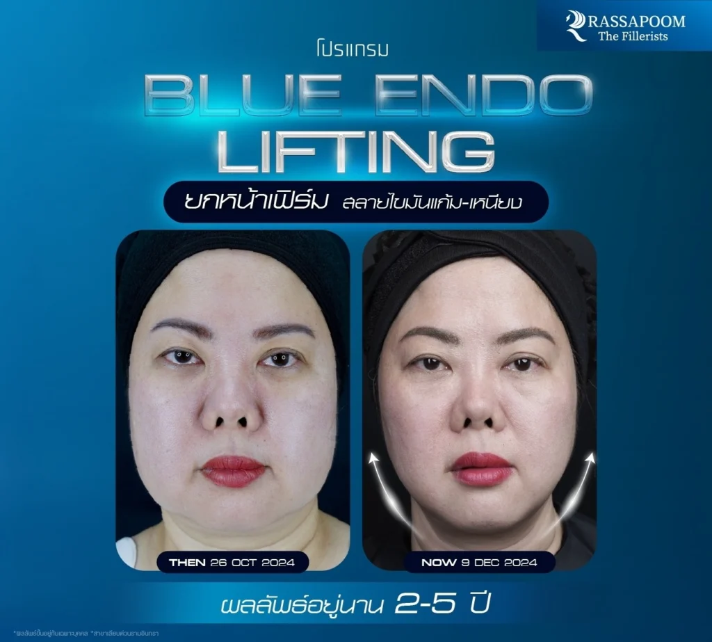 ผลลัพธ์หลังทำ โปรแกรม Blue Endo Lifting