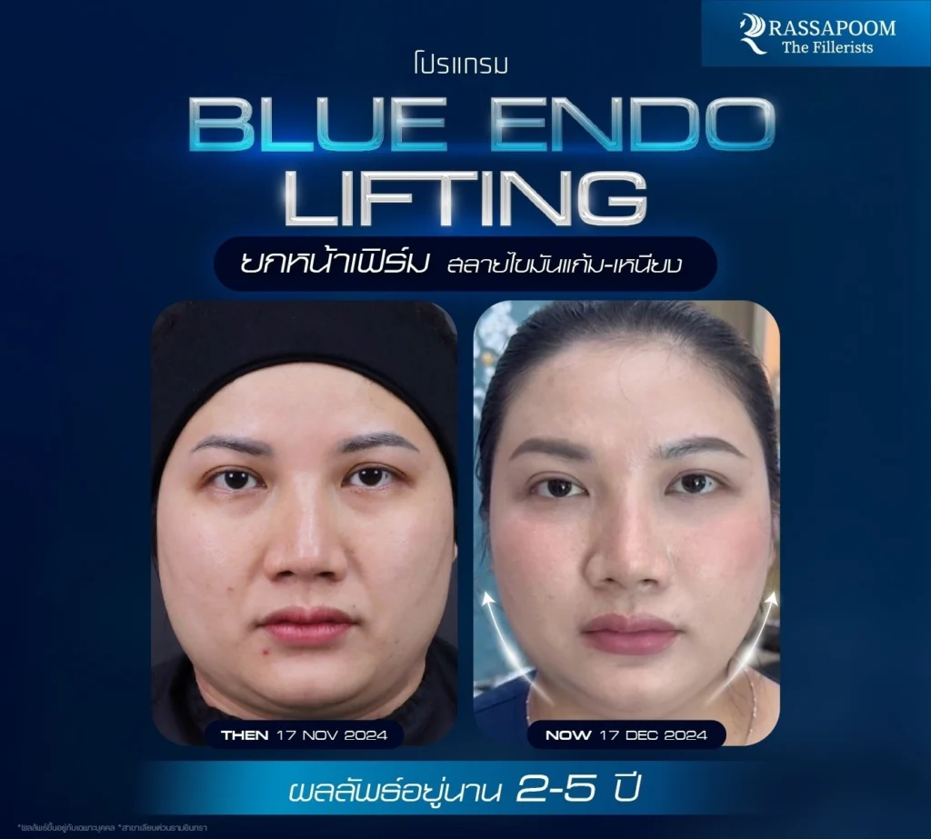 ผลลัพธ์หลังทำ โปรแกรม Blue Endo Lifting