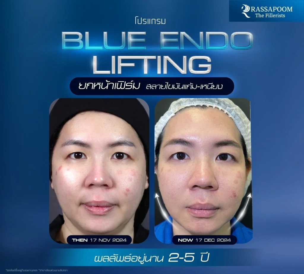 ผลลัพธ์หลังทำ โปรแกรม Blue Endo Lifting