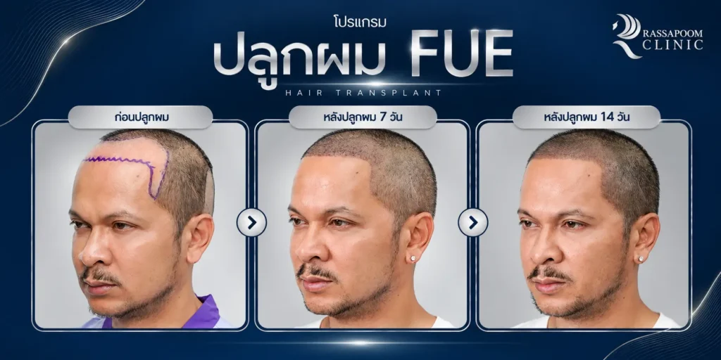 FUE Hair Transplant Progress Showcase