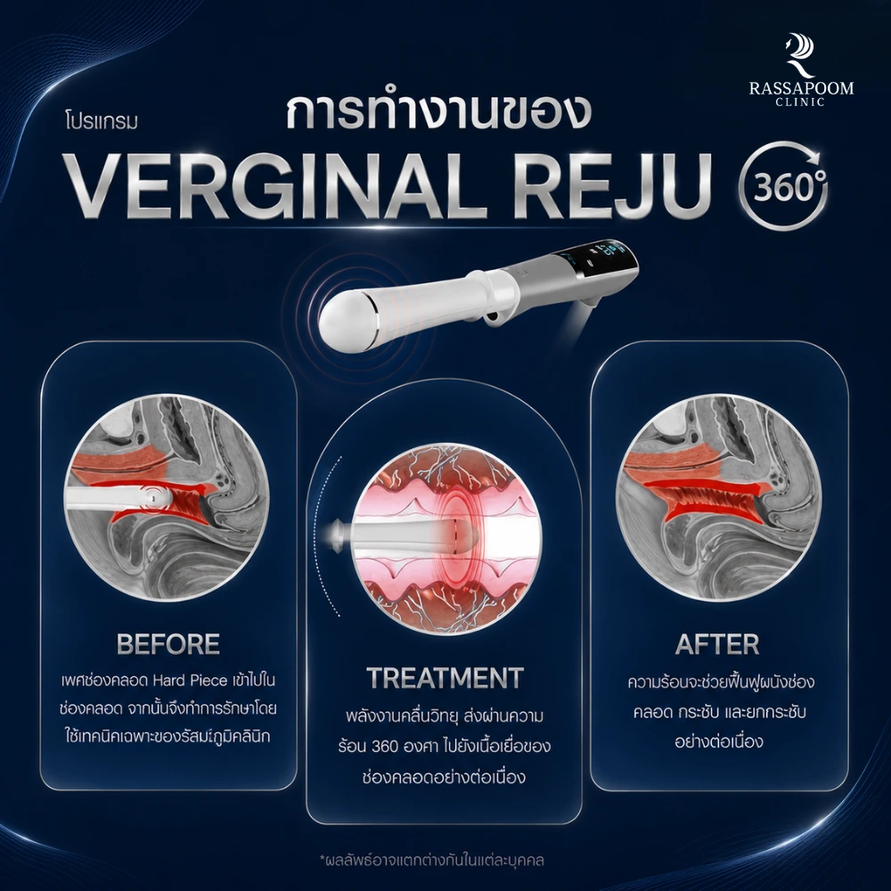 การทำงานของ โปรแกรม Vaginal Reju
