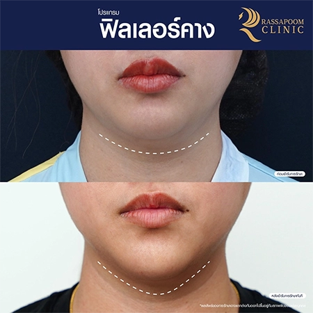 ผลลัพธ์หลังการทำโปรแกรมฉีดฟิลเลอร์คาง