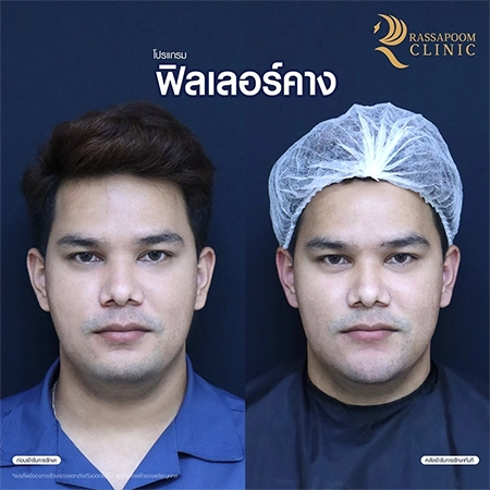 ผลลัพธ์หลังการทำโปรแกรมฉีดฟิลเลอร์คาง