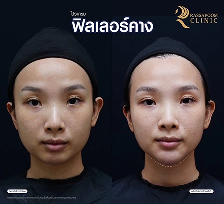 ผลลัพธ์หลังการทำโปรแกรมฉีดฟิลเลอร์คาง