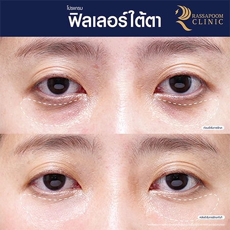 ผลลัพธ์หลังฉีดโปรแกรมฟิลเลอร์ใต้ตา