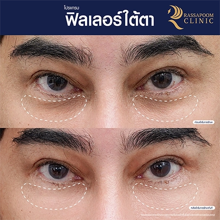 ผลลัพธ์หลังฉีดโปรแกรมฟิลเลอร์ใต้ตา