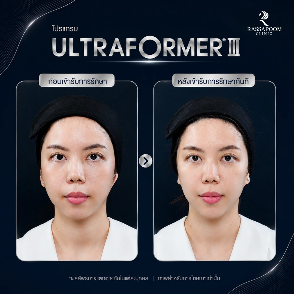 ผลลัพธ์หลังทำ โปรแกรม Ultraformer III